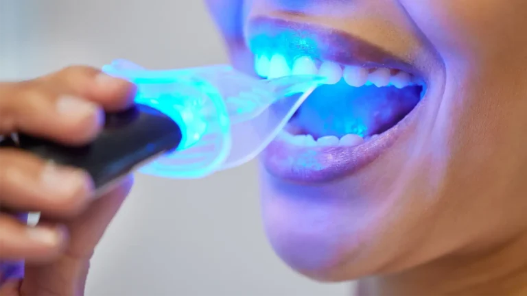 Teeth Whitening at Afsoon Beauty Lounge, Richmond Hill